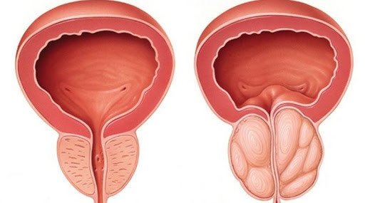 Prostat Belirtileri Nelerdir? 7 prostat belirtileri