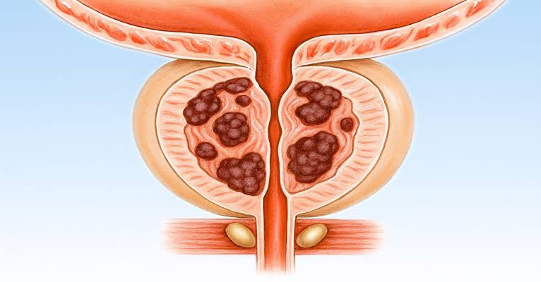 Prostat Kanseri Nedir? Tedavisi Nasıl Yapılır? 27 prostat kanseri izmir