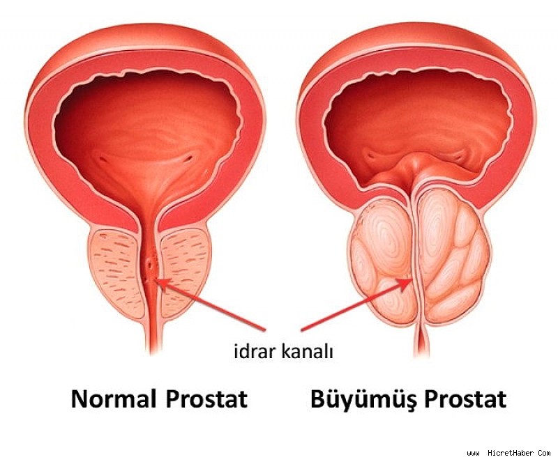 prostat-tedavisi-izmir